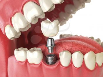 Tooth human implant. Dental concept. Human teeth or dentures. 3d illustration