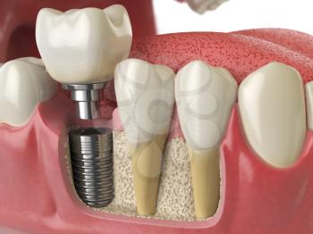 Anatomy of healthy teeth and tooth dental implant in human dentura. 3d illustration