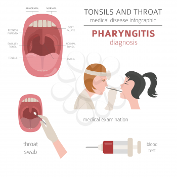 Tonsils and throat diseases. Pharyngitis symptoms, treatment icon set. Medical infographic design. Vector illustration