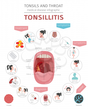 Tonsils and throat diseases. Tonsillitis symptoms, treatment icon set. Medical infographic design. Vector illustration