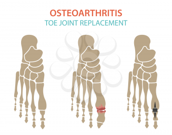 Arthritis, osteoarthritis medical infographic design. Joint replacement, implantant. Vector illustration