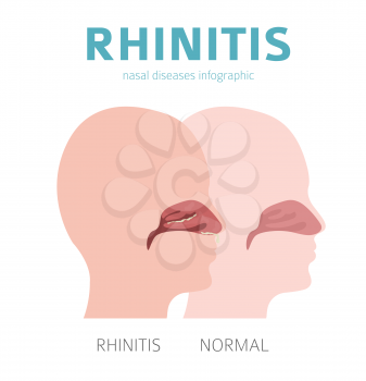 Nasal diseases. Rhinitis symptoms, treatment icon set. Medical infographic design. Vector illustration