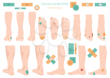 Callus, corn and blister feet and hands. Dermatology. Medical desease infographics collection. Vector illustration