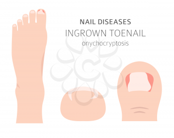 Nail diseases. Onychocryptocosis, ingrown toenail. Medical infographic design.  Vector illustration