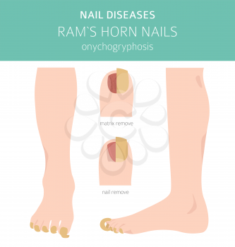 Nail diseases. Onychogryphosis, Ram`s horn nail. Medical infographic design.  Vector illustration