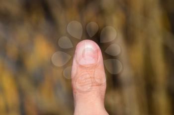 Forked nail on the thumb. Dilation of the nail, traumatic pathology. The nail is divided in half.