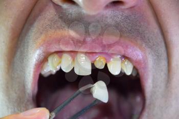 Dental prosthesis of metal ceramics in tweezers. A patient without a tooth is trying on a denture. Tooth implantation, dental treatment.