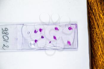 Slices of the tumor under glass. Histological examination of tumor cells for the presence of cancer. Samples of tumor cells under the sleek against the background of the lamp.