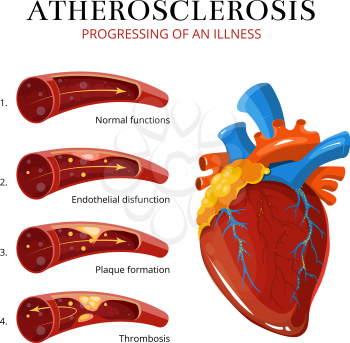Atherosclerosis, blood clot formation. Vector medical illustration. Internal organ, thrombosis and endothelial
