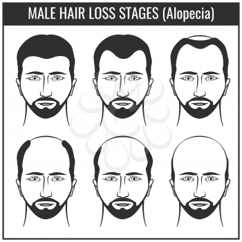 Hair loss stages and types of baldness. Man hairs problem vector charts. Problem with hair, illustration of hair loss