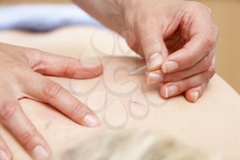 Royalty Free Photo of Acupuncture