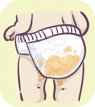 Illustration of a Baby Wearing Diaper with Poop. A Kid Having Diarrhea