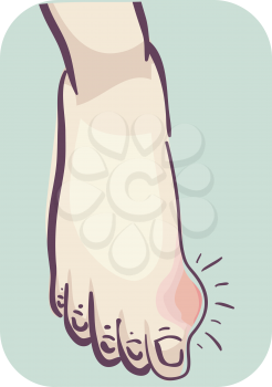 Illustration of a Foot with Lump Near Thumb. Gout Symptom