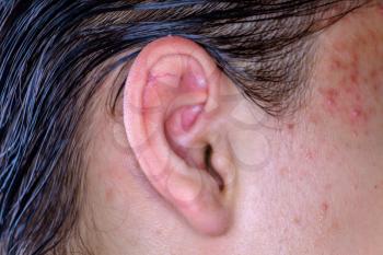 Acne on the skin of the face near the ear macro image. Male skin of the face with inflammations. Teenage Boy's ear