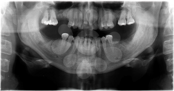 Panoramic dental X-Ray images with teeth for medicine and dentistry design
