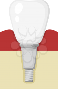 Vector chematic illustration of a prosthetic tooth. Cartoon style prosthetic tooth on a white 
background. Dental operation