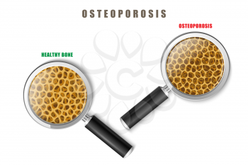 Color image of a human bone in cut with medicine problem of osteoporosis on a white background with magnifying glasses Vector item Osteoporosis under a microscope research invention treatment.