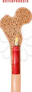 Color image of human thigh bone in cut with medicine problem osteoporosis on white background. Vector  item concept of a hidden disease osteoporosis in the form of dynamite sticks with a lit wick