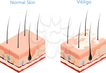Cut human skin in isometric style on a white background isolated  Medicine problem skin vitiligo Vector illustration of vitiligo disease and healthy skin poster for the study of medical subjects