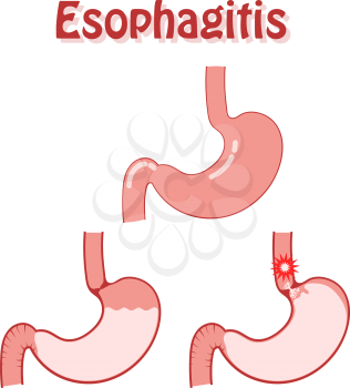 Human stomach in a flat style on a white background. Disease esophagitis. Problem of digestion, medical diagnosis, symptoms and causes of esophagitis. Work of the sphincter. Vector illustration