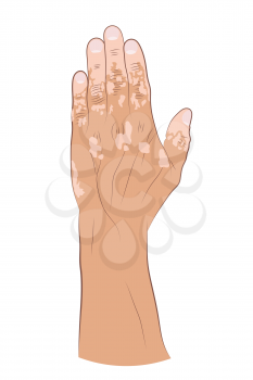 Medical Illustration of the effects of vitiligo
