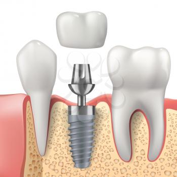 Teeth and dental implant realistic vector design of dentistry. 3d tooth, denture crown, jaw bones and healthy roots, implant screw and abutment, healthcare, dentist and orthodontist treatment