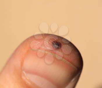 blood blister on finger injuried with an accidental hammer blow
