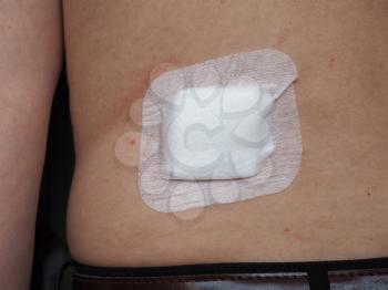 antibacterial woundpad island dressing for surgical wound care