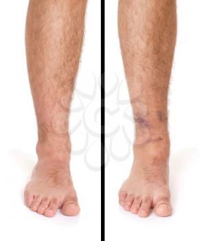 Royalty Free Photo of a Sprained Ankle