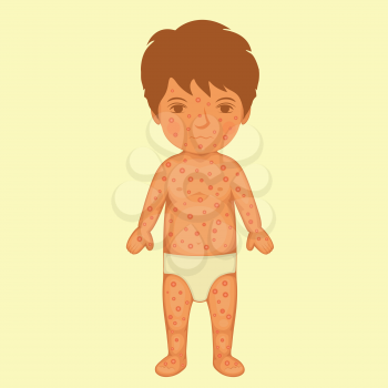 sick child, skin rash, chicken pox disease