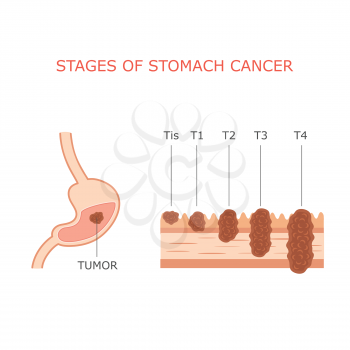 stomach cancer stages, human gastric tumor anatomy, digestive system