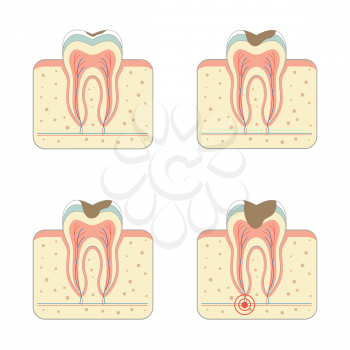 tooth decay disease, dental root tinfection