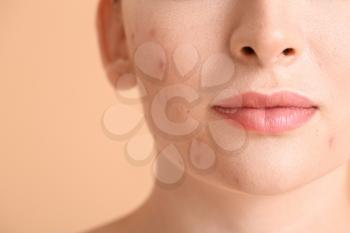 Young woman with acne problem on color background, closeup�