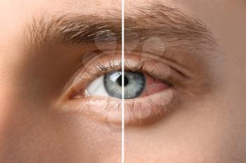 Young man without and with eye redness, closeup�