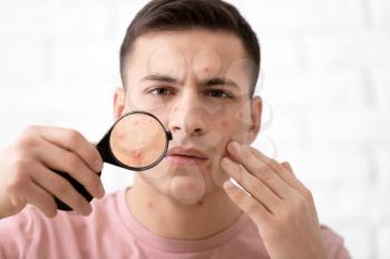 Portrait of young man with acne problem and magnifier against light background�