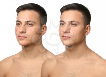 Young man with and without acne problem on white background�