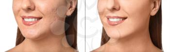 Young woman with and without acne on white background�