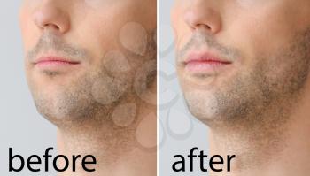 Young man before and after plastic operation on light background, closeup�