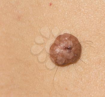 a mole on the skin. macro