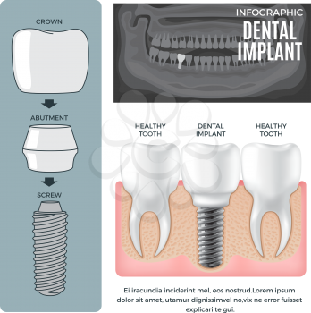 Infographic dental implant structure info poster with colourless picture of human jaw. Vector illustration of dental implant structure screw with abutment near crown and comparison with healthy tooth