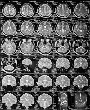 MRI of the brain. skull X-ray