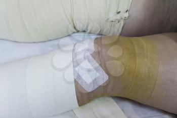 Photo of the two legs with bandage
