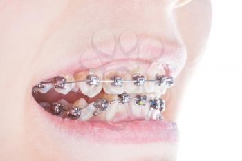 dental brackets on teeth close up during orthodontic treatment