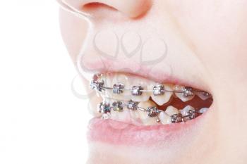 dental steel braces on teeth close up during orthodontic treatment