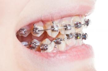 side view of dental brackets on teeth close up during orthodontic treatment