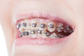 dental steel brackets on teeth close up during orthodontic treatment