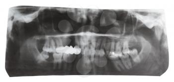 dental X-ray picture of human jaws isolated on white background