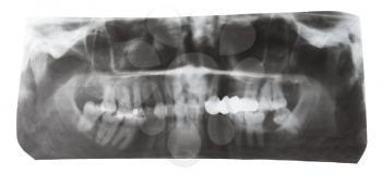 dental X-ray picture of human teeth isolated on white background