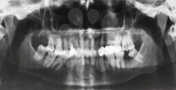 front view of human jaws with dental crown and pins in teeth on X-ray image