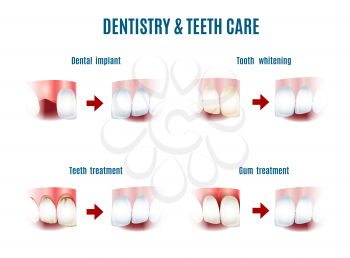 Dentistry treatment and main teeth care procedures. Iplants, whitening, gum and oral cavity. Free font Antonio used. Isolated on white